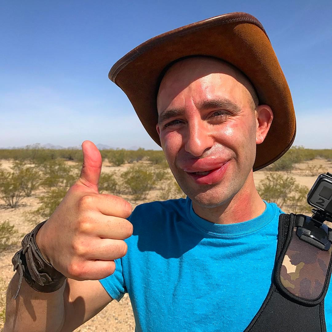 The painful aftermath of the bee challenge