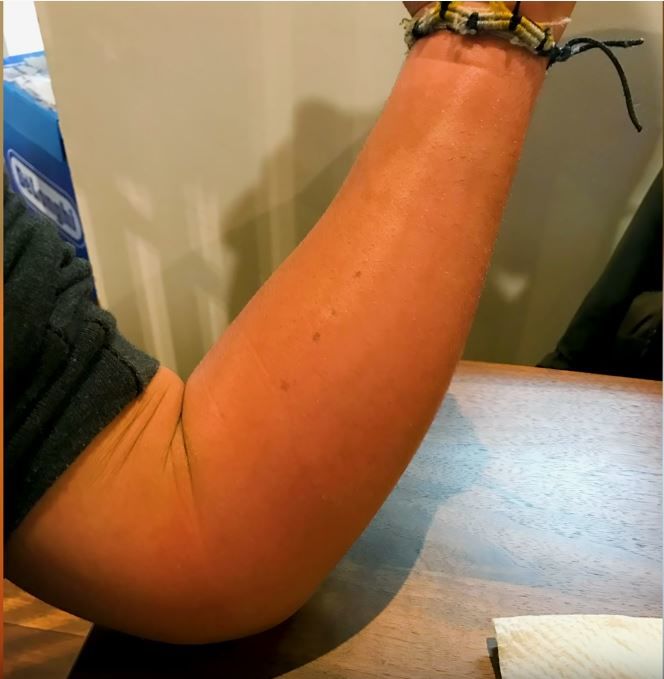 The hornet sting turned his entire hand bright red