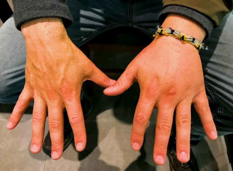 Even his fingers swelled up badly