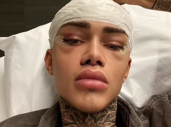 Murphy endured pain and spent a fortune just to change his face