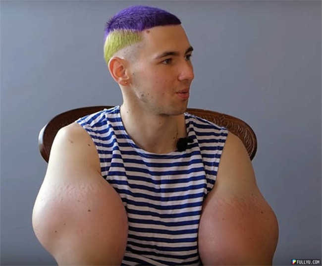 Kirill’s overuse of injected chemicals has severely distorted his muscles