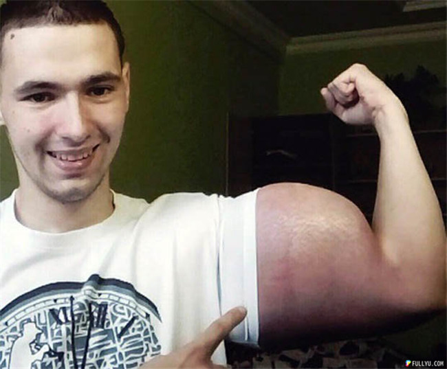 A clear photo showing Kirill’s muscle distortion