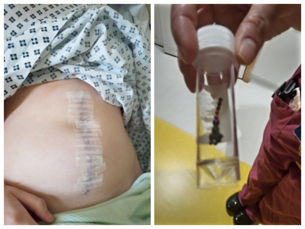 11-Year-Old Gamer Swallows Magnets Trying TikTok Trend, Ends Up in Surgery 2 Nearly 13cm of intestine had to be removed