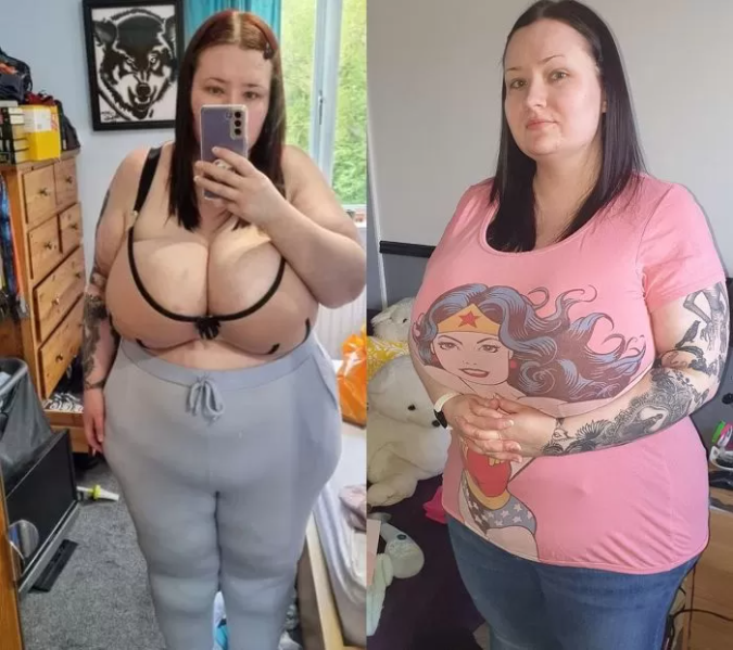 Woman Struggles with 25kg Bust and Hospital Surgery Denial 2 Laura has an enormous bust weighing 25kg