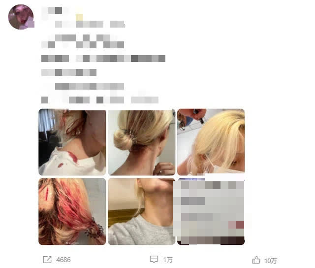 Chinese Model Tiểu Hồng Shares Shocking Abuse Photos from Boyfriend 2 Tia Hng shared multiple photos showing her serious injuries