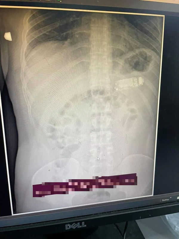 Endoscopy image showing the gamer’s stomach