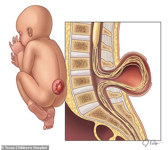 Spina bifida can cause babies to have tails, but these are pseudo-tails.