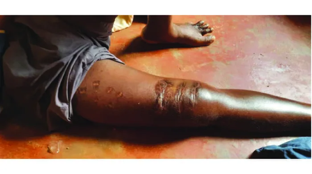 Severe injuries Alexander Chimedza suffered from the crocodile attack