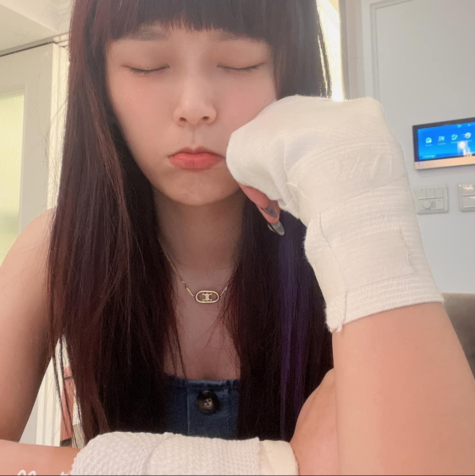 Streamer Diodiumei Injured by Hot Oil During Live Cooking Stream 5 Her swollen, bandaged hands