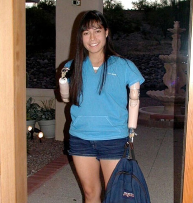 Jessica wore prosthetic arms for 11 years before deciding to give them up.