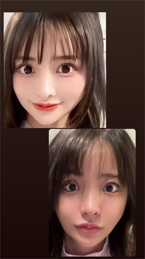 Shirahama Nozomi Quits After Cosmetic Surgery Disaster 2 Eyelid surgery aftermath