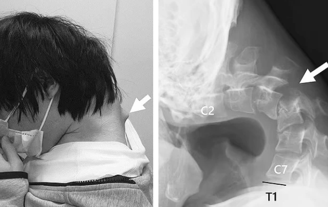 The Hidden Dangers of Long Gaming Sessions Revealed 2 This case was published in JOS Case Reports with patient and family consent.