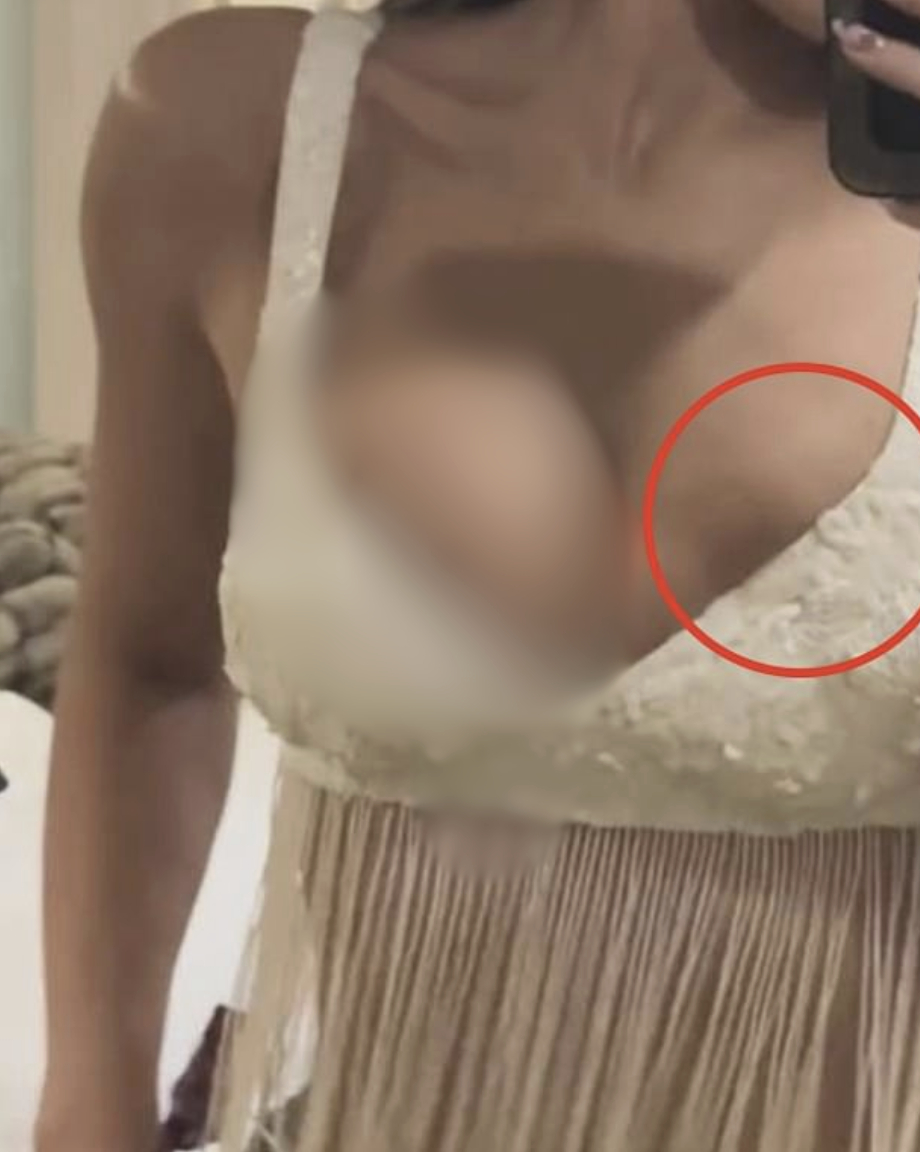 Did Kylie Jenner’s Breast Implant Rupture at Coachella? 6 Fans point out a suspicious bulge on Kylie’s left breast that might indicate implant issues.