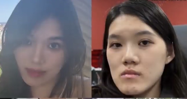 24-Year-Old Woman's Face Permanently Disfigured After Surgery 2 Xiaoyu confronting her surgeon