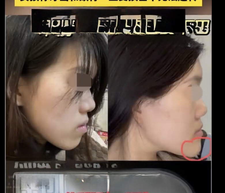 24-Year-Old Woman's Face Permanently Disfigured After Surgery 1 Xiaoyu's disfigured jaw after surgery