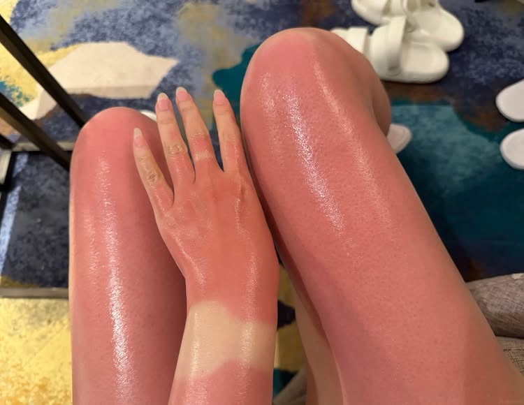 The Hidden Pain Behind Stunning Summer Beach Photos 5 Woman applying sunscreen on her shoulder