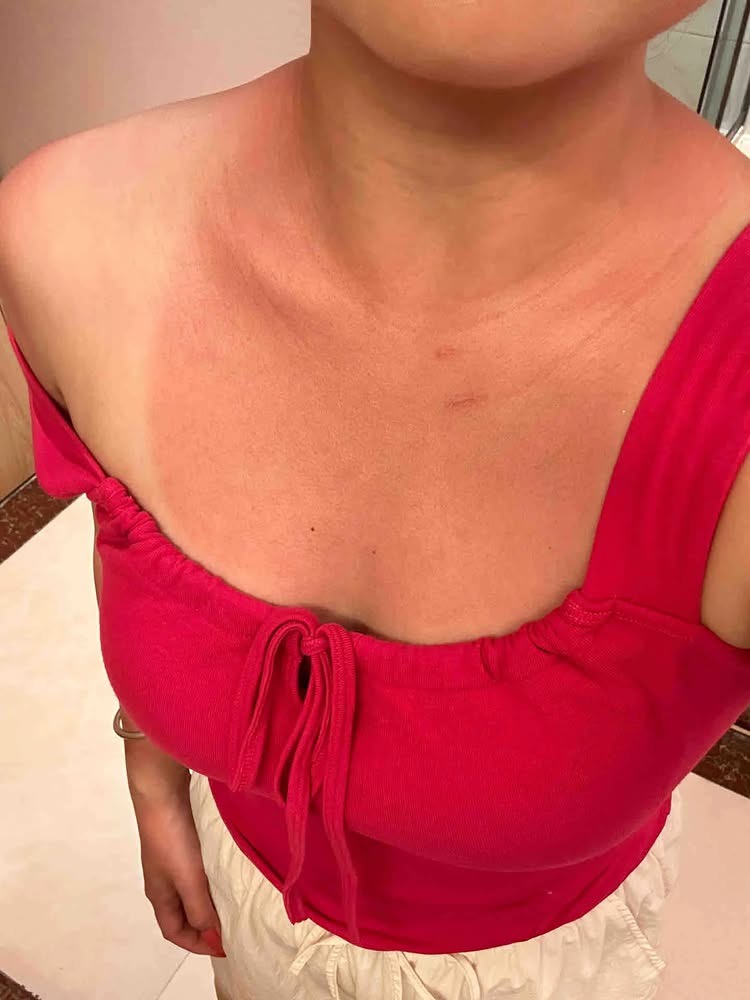 The Hidden Pain Behind Stunning Summer Beach Photos 3 Red sunburn marks on chest and neck