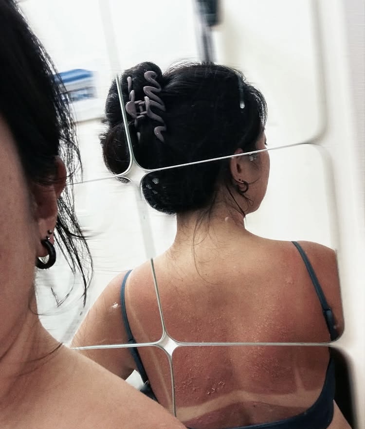 The Hidden Pain Behind Stunning Summer Beach Photos 2 Sunburned back with bikini tan lines